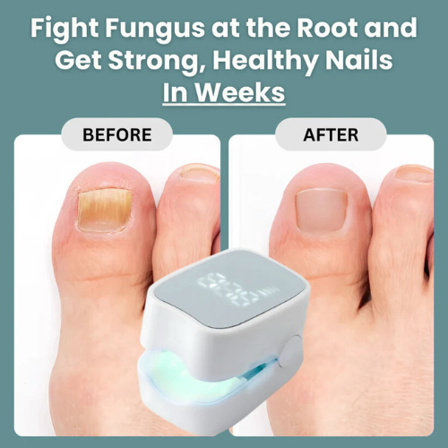Onars Pro™ - Nail Fungus Laser Device