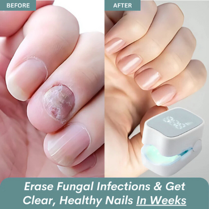 Onars Pro™ - Nail Fungus Laser Device