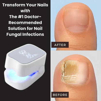 Onars Pro™ - Nail Fungus Laser Device